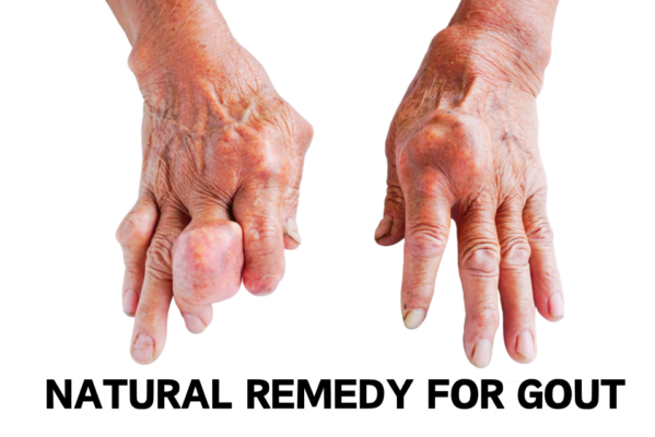 natural remedy for gout